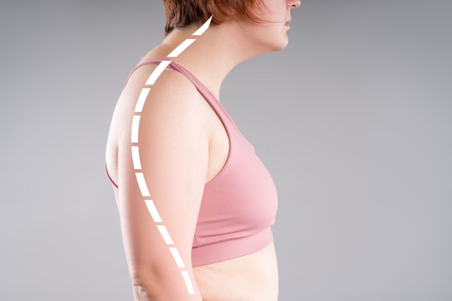 Mujer con lordosis cervical